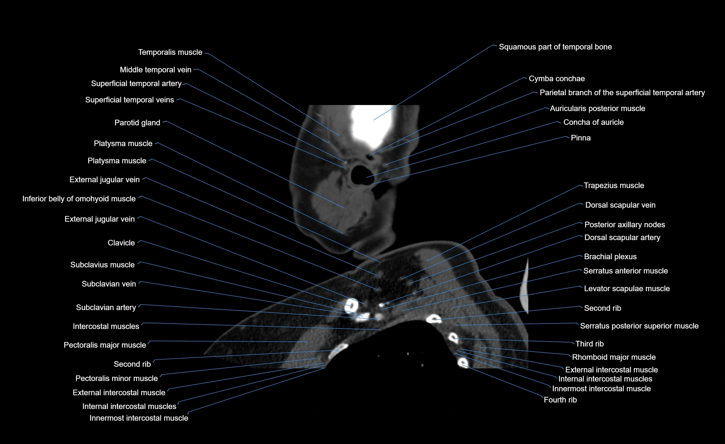 Neck CT sagittal cross sectional anatomy 3D  radiology  image-img-00001-00024.webp